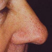 Visszérbetegség tünetei és kezelése Az arcon fellépő visszér okai
