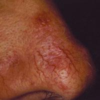 Visszérbetegség jelei az arcon | MKHOA